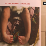 Journée mondiale du pied bot : SHIPHRA sensibilise à l’importance du dépistage précoce